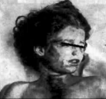 Mary Phagan autopsy photo; the indentation in her neck from the cord which strangled her clearly visible